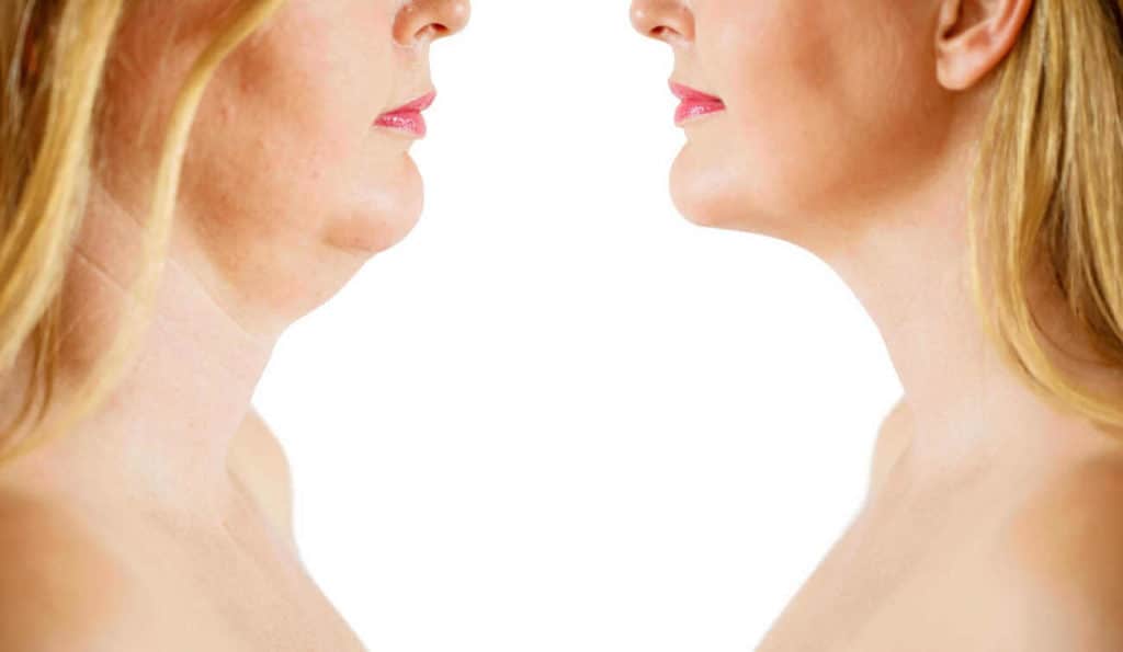 Double Chin treatment Earl's Court before and after results