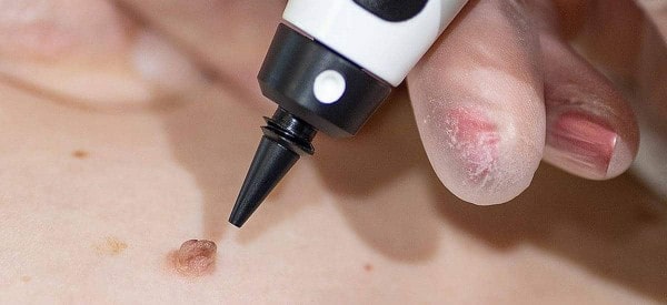 After Skin Tag Removal Earl's Court