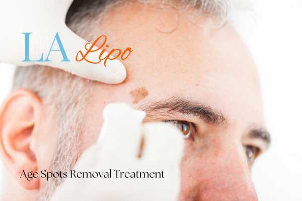 What Are the Most Effective Treatments for Age Spots Earl's Court?