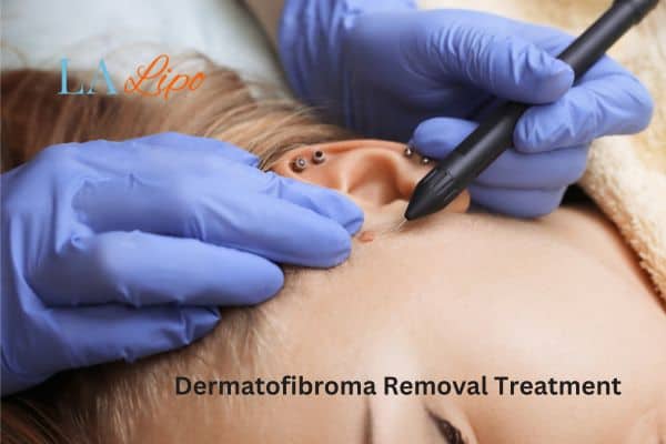 Dermatofibroma Removal Treatment Earl's Court