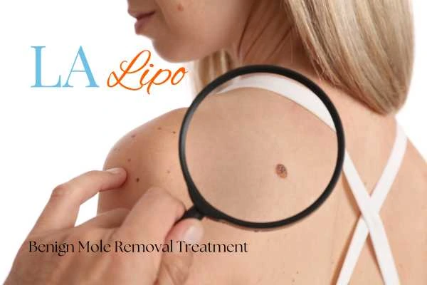 Woman having her inspection of blemish before mole removal Earl's Court