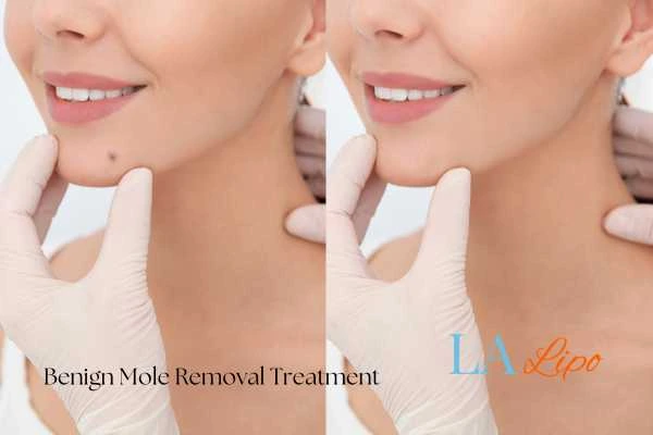woman's before and after mole removal Earl's Court results
