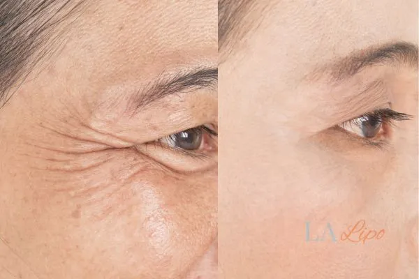Before and after results of woman - HI-fu wrinkles reduction treatment Earl's Court