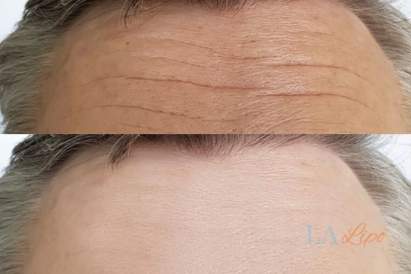 results of HIFU Earl's Court on mans forehead to help reduce lines and wrinkles