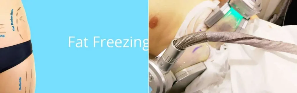 multi areas of a persons body having coolsculpting Earl's Court treatment