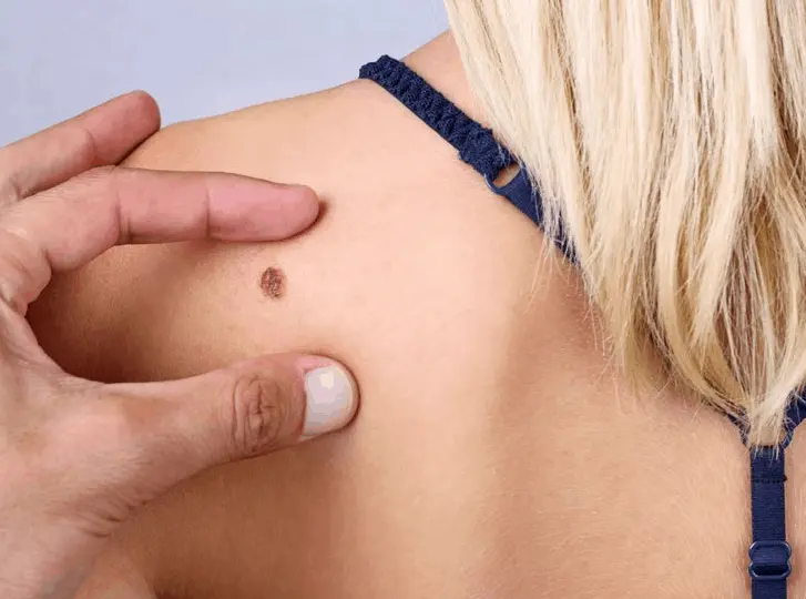 woman having mole removal Earl's Court consultation before treatment.
