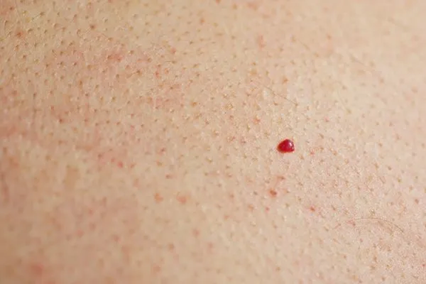 close up of a cherry angioma Earl's Court