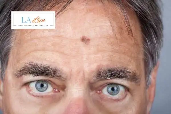 Solar Lentigo Removal Earl's Court image of man with mark on his forehead