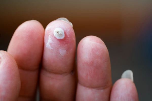 wart on person finger - cryotherapy to treat from LA LIPO Earl's Court