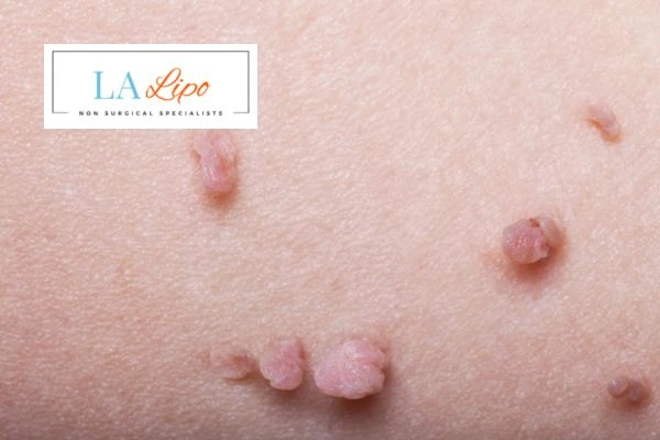 Does cryopen skin tag removal Earl's Court hurt? Find out now call our team today!