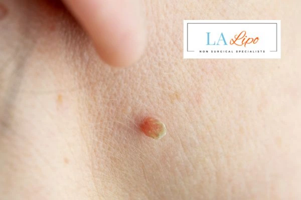 Book skin tag removal Earl's Court today speak to our team now!