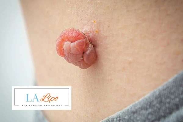 Interested in skin tag removal Earl's Court? Concerned about the pain? Find out more today!
