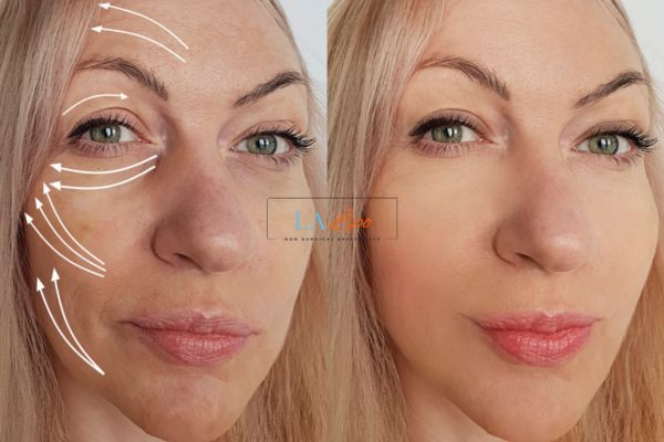 Morpheus 8 results Earl's Court face lift.