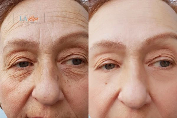 The powerful benefits of Morpheus8 Treatment Earl's Court - Call Our team today!