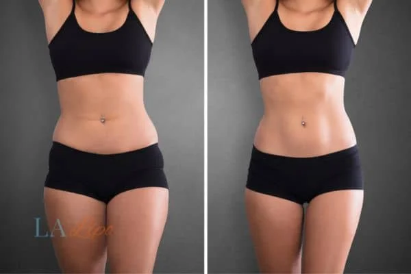 before and after results of non-surgical treatment to help a woman's body image and mental health Earl's Court