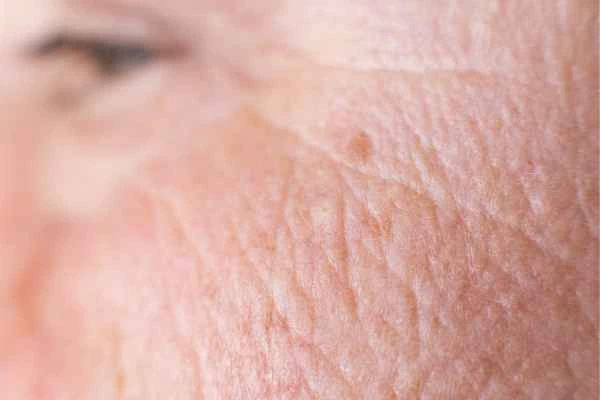 close up picture of a woman's face showing an age spot Earl's Court