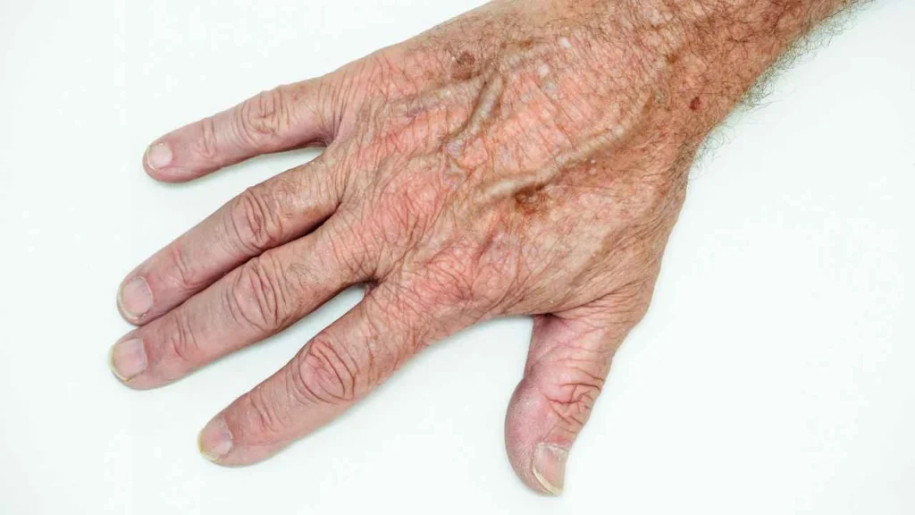 Male hand showing age spot Earl's Court