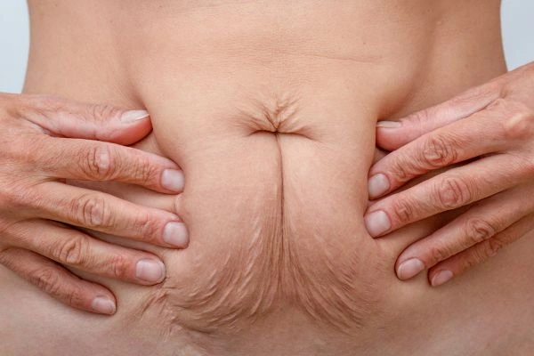 Image of a woman's stomach with loose skin - example of skin tightening Earl's Court options